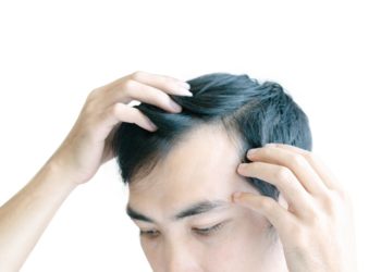 homem com falta de cabelo, minoxidil funciona