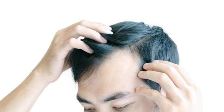 homem com falta de cabelo, minoxidil funciona