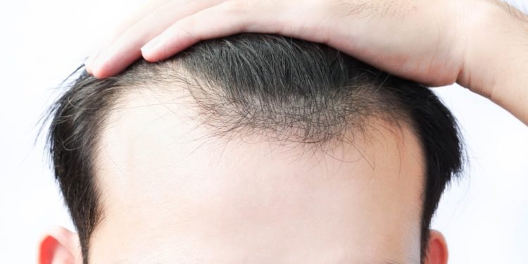 minoxidil para que serve