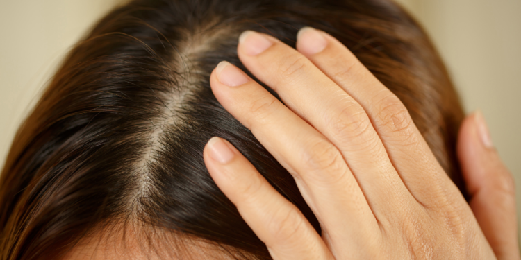 alopecia androgenética