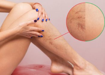 Picnogenol: ajuda no tratamento de melasma