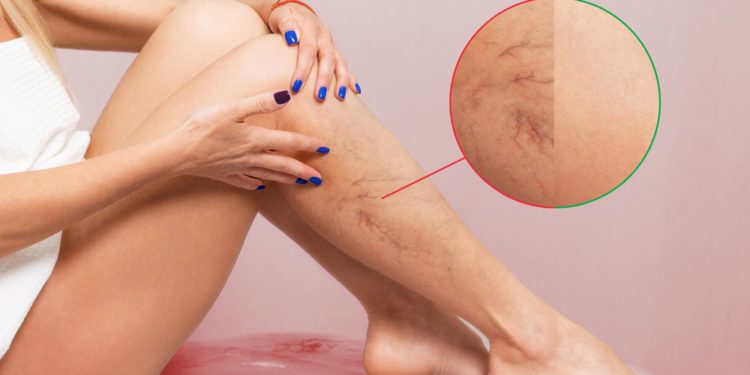 Picnogenol: ajuda no tratamento de melasma